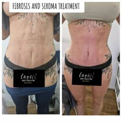 pre seroma fibrosis treatment and post seroma fibrosis treatment